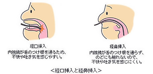 経口挿入　経鼻挿入